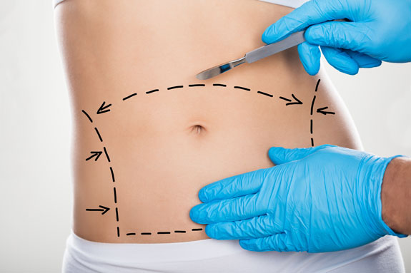 Abdominoplastik Passau
